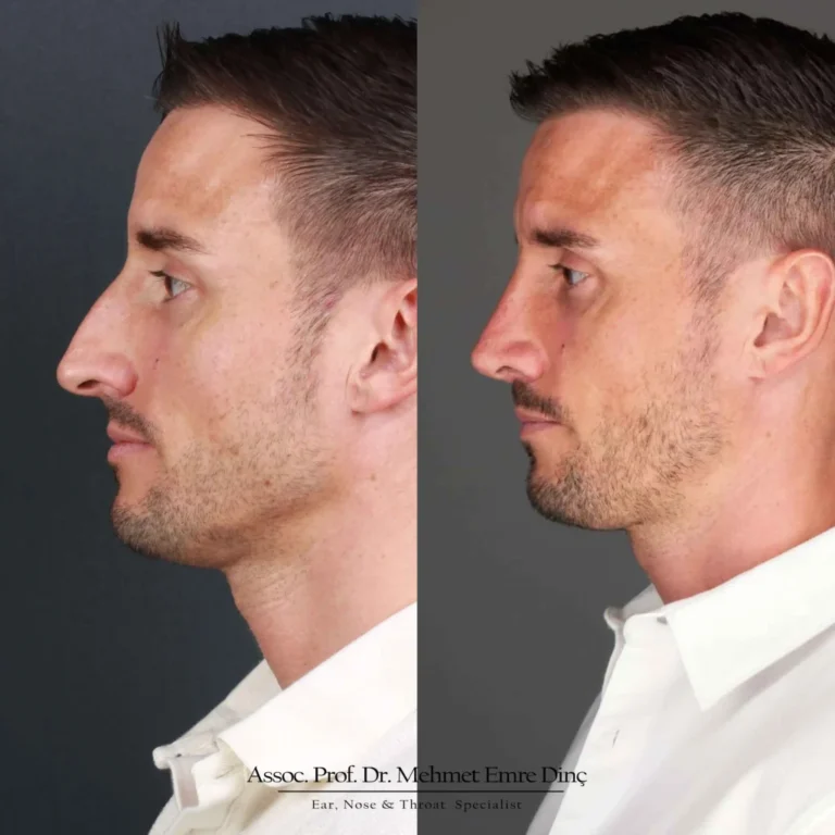 Turkey Rhinoplasty Prices Explained: A Complete Guide for Patients