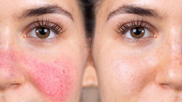 Essential Rosacea Skin Care Tips for Australians: A Comprehensive Guide