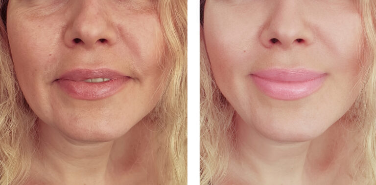 The Benefits of Choosing Dermal Fillers Near Me: Enhancing Your Natural Beauty