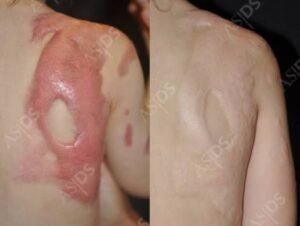 Is Laser Scar Removal Right for You? Benefits, Risks, and Recovery